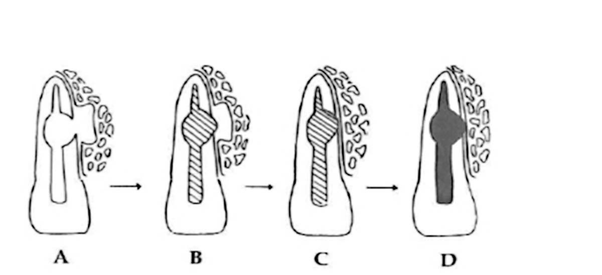 Tratamiento De La Reabsorci N Radicular Interna Perforante Con Mta