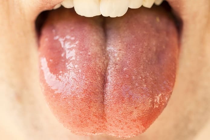La caracterización de la microbiota bucal en hombres de mediana edad con y sin infección por el virus del papiloma humano (VPH).