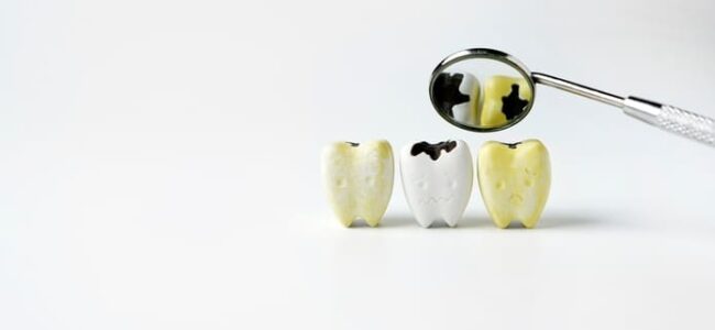 Caries dental y otras condiciones que también tienen como resultado la pérdida de minerales de los dientes.