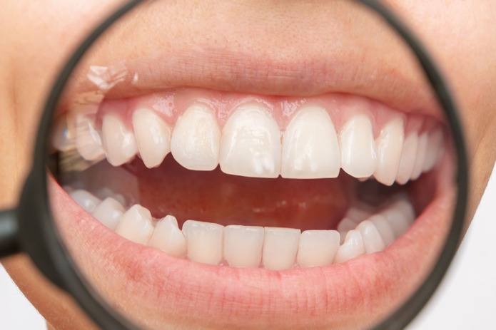 Revisión sistemática alteraciones del esmalte dental en la enfermedad celiaca