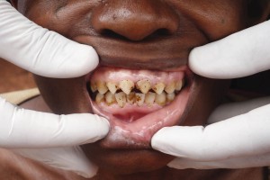 Tallado dental típico del pueblo pigmeo Baka de Camerún.