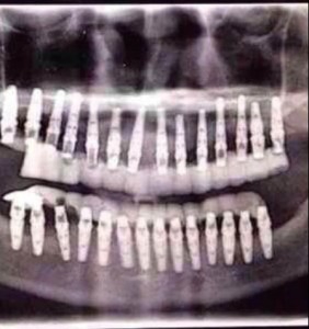 Veintiocho implantes para veintiocho piezas dentales. Todo un récord difícil de superar. 