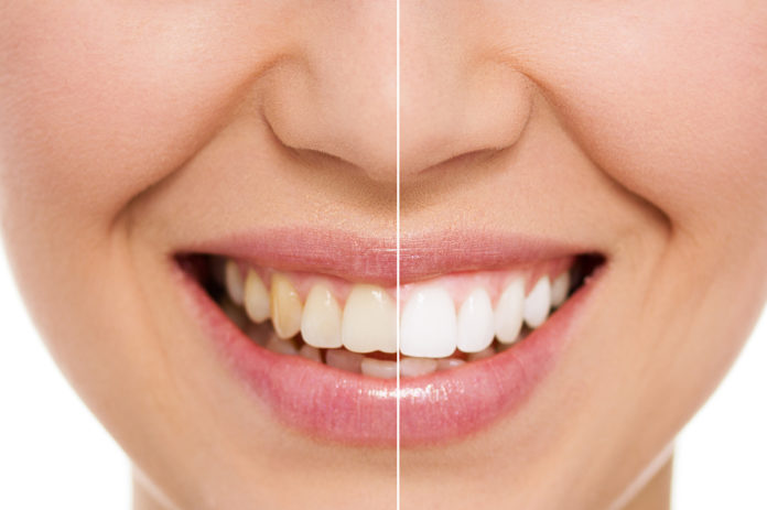 blanqueamiento-dental Blanqueamiento dental