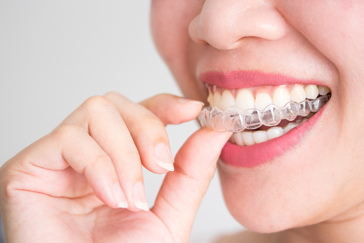 La estética, motivo principal para someterse a un tratamiento de Ortodoncia según una encuesta de Sanitas - Gaceta Dental