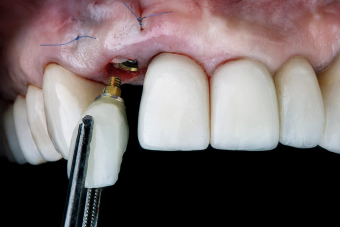 Implantes dentales inteligentes con nanopartículas y fuentes de luz.