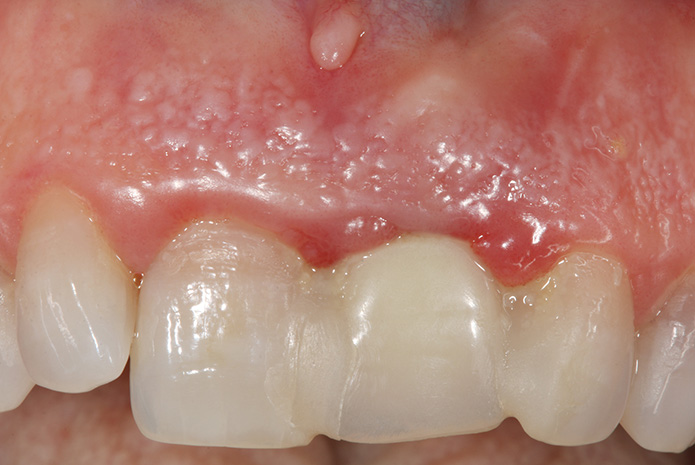 Reversibilidad en los tratamientos de Implantología oral