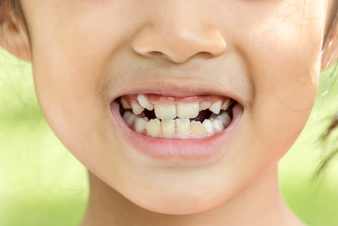 Un estudio revela la verdadera causa de los dientes de tiza en niños.