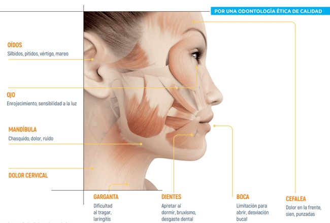 Ilustración de zonas afectadas y síntomas de la disfunción de la articulación temporomandibular.