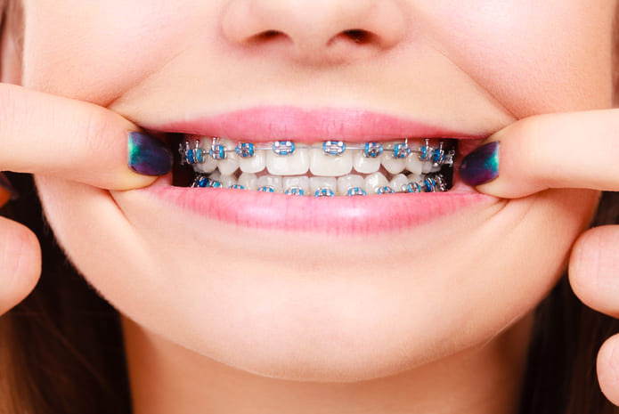 La SEDO anima a acudir a revisiones tempranas para garantizar la vida de las dentaduras en el Día Mundial de la Ortodoncia