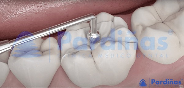 Imagen 3D de una incrustación dental, uno de los posibles tratamientos para casos de erosión en los dientes.