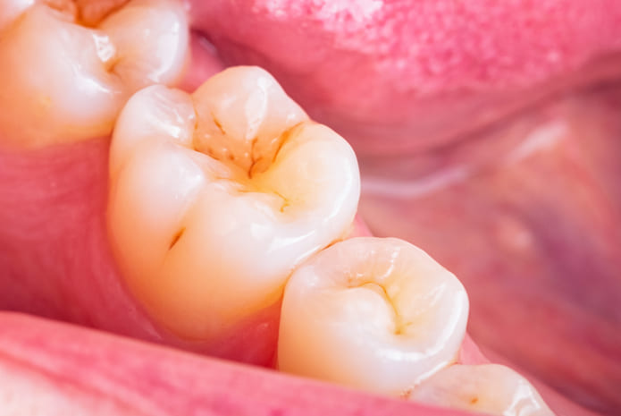 University of Washington develops tool that can detect acidic conditions that lead to tooth decay