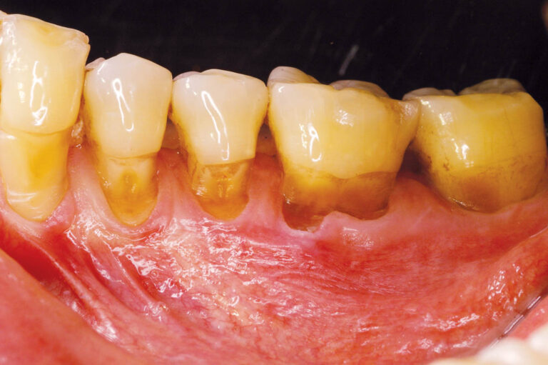 Tratamiento de la hipersensibilidad dentinaria apoyado en la odontología conservadora