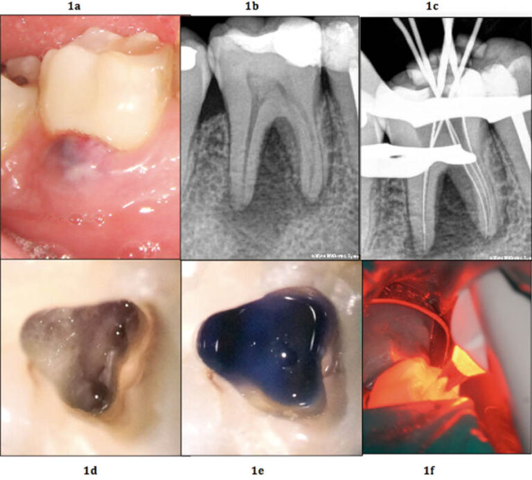 Terapia fotodinámica en un primer molar mandibular con periodontitis apical crónica e istmo intermesial permeable
