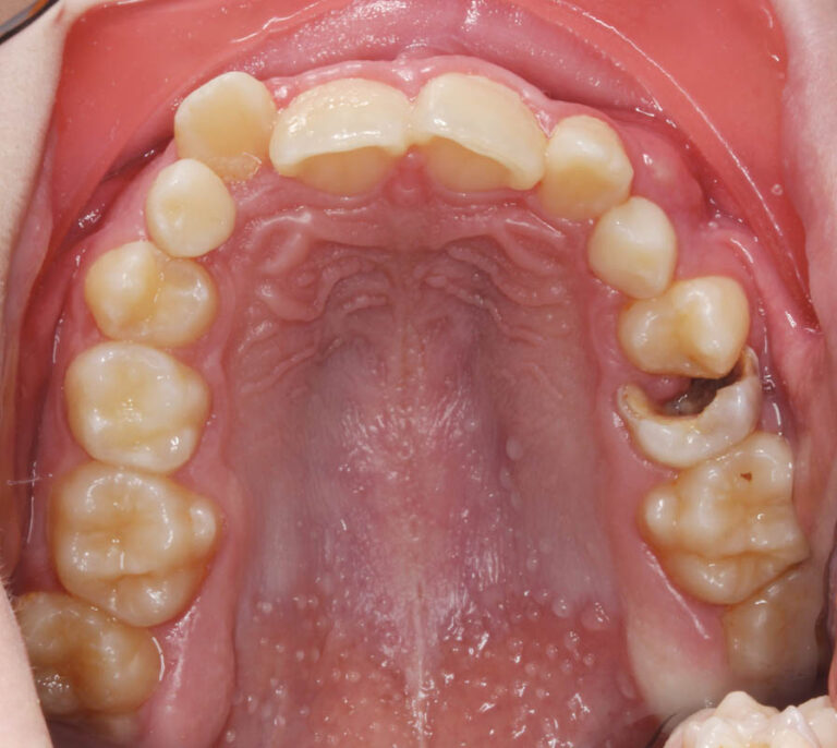 Diagnóstico y tratamiento de premolares incluidos en el maxilar superior