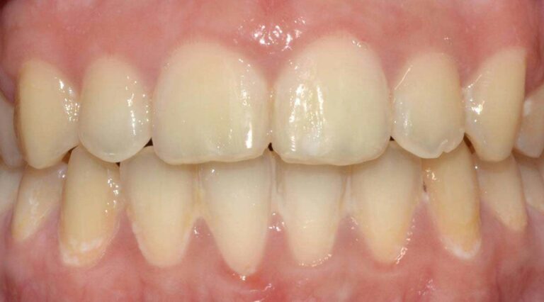 Recidiva y mantenimiento del color dentario tras un tratamiento domiciliario con peróxido de carbamida