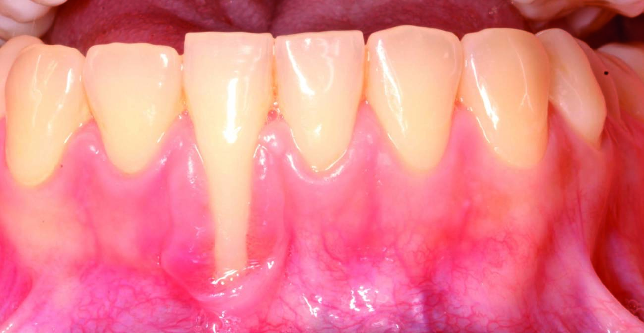 clasificación de la recesión gingival