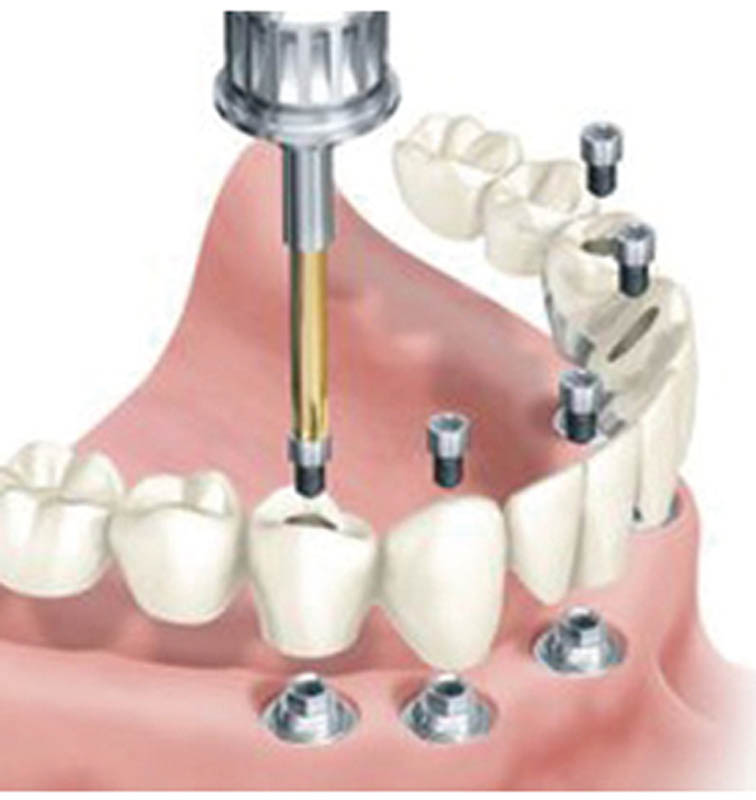 Complicaciones mecánicas en prótesis fijas implantosoportadas