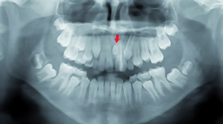 Estudio retrospectivo sobre la presencia de dientes supernumerarios asociados a patologías locales en el paciente pediátrico