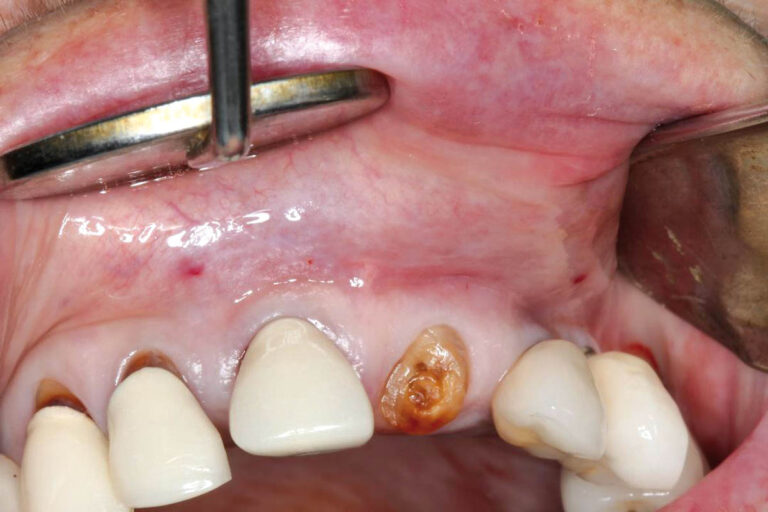 Tratamiento de defectos óseos en ausencias dentales