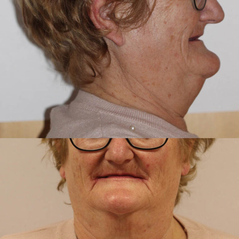 Implantes cigomáticos y pterigoideos para el tratamiento del prognatismo mandibular