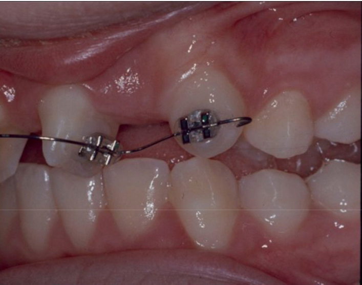 Tratamiento en dos fases de un caso con dientes supernumerarios