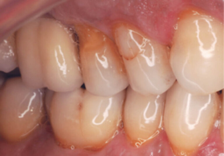Aplicaciones del láser Er:YAG en Odontología Conservadora