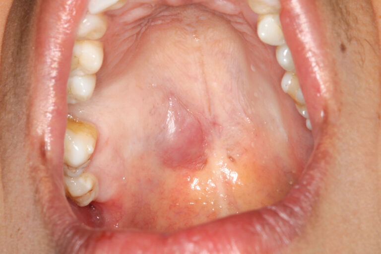 Las glándulas salivales del paladar como localización infrecuente del adenoma de células basales