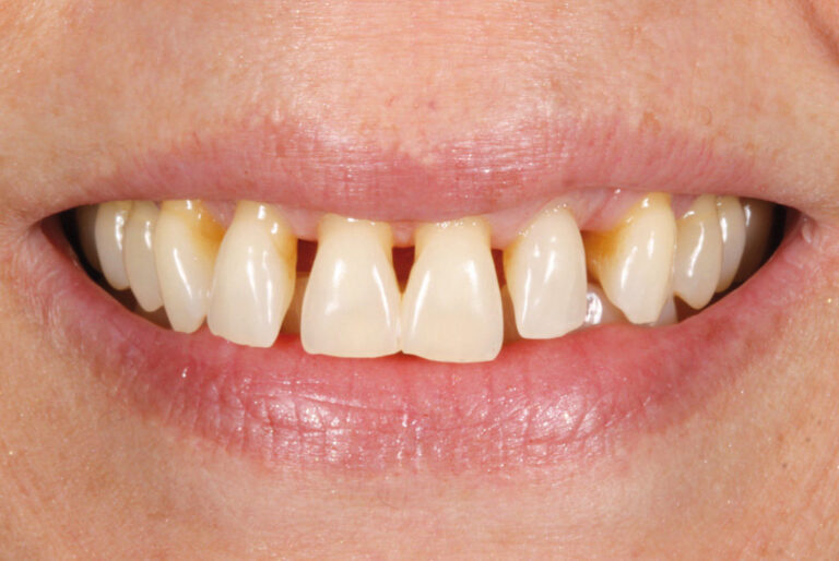 Rehabilitación mediante facetas de porcelana en el paciente periodontal