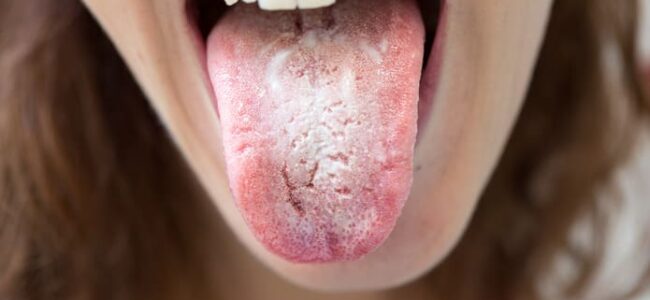 ¿Qué es la candidiasis oral?
