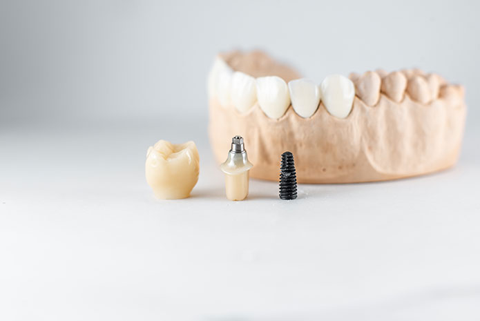 Soluciones CAD/CAM sobre implantes dentales: un antes y un después