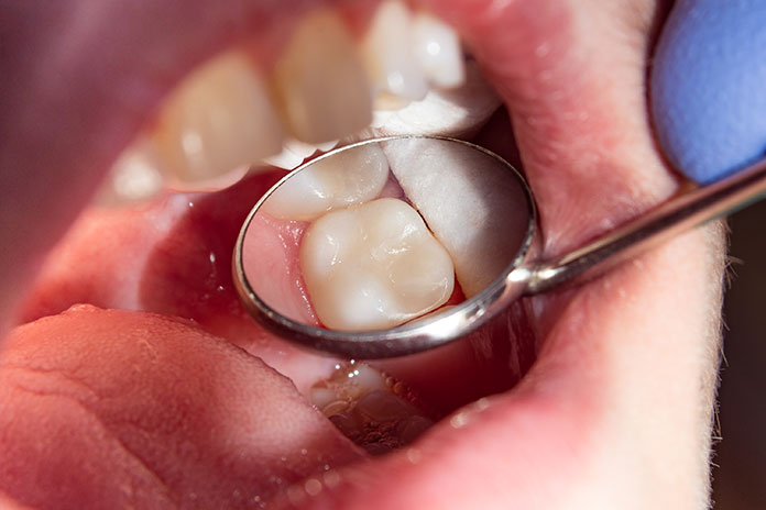 Feudo retirada Avanzar El 10% de la población no desarrolla las muelas del juicio - Gaceta Dental
