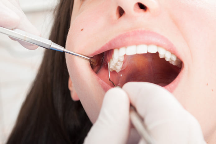 Un estudio determina una frecuente diagnosis errónea de los queratoquistes odontogénicos.
