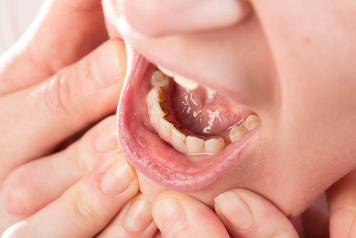 ¿Cuáles son las enfermedades dentales más comunes?