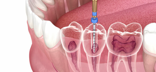 Un estudio de EE.UU analiza el tiempo de supervivencia de los dientes con endodoncia. Imagen: Alex Mit. Shutterstock.
