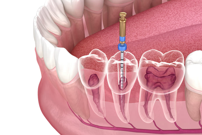 Un estudio de EE.UU analiza el tiempo de supervivencia de los dientes con endodoncia. Imagen: Alex Mit. Shutterstock.