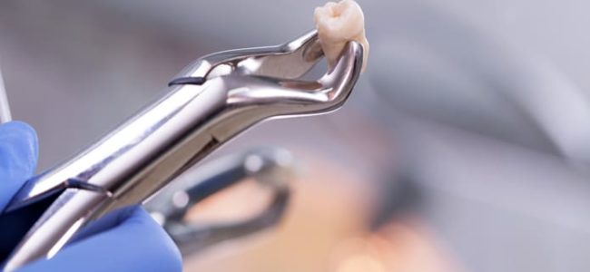 Contestamos algunas preguntas frecuentes sobre la extracción dental o exodoncia