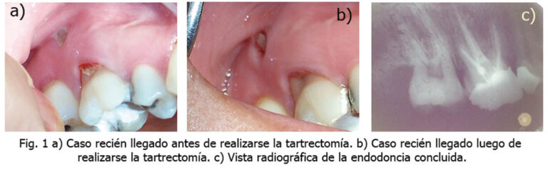Tratamiento integral de lesión endoperiodontal en molar con dehiscencia ósea