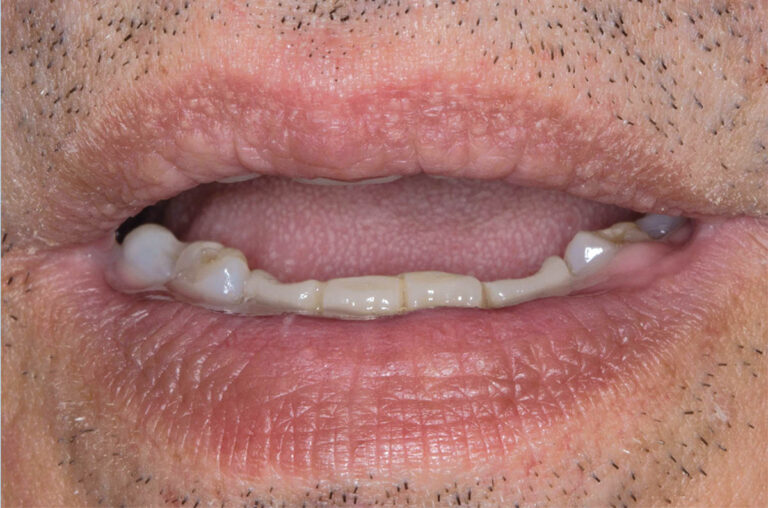 Rehabilitación oral del paciente periodontal