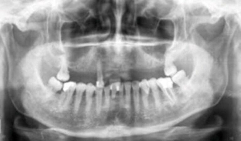 Rehabilitación fija del maxilar superior con carga inmediata