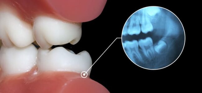 Cómo saber si te están saliendo las muelas del juicio: síntomas y qué hacer.