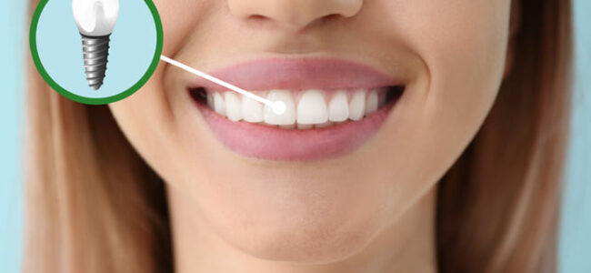 Al menos 2 de cada 10 españoles con implantes dentales tiene periimplantitis