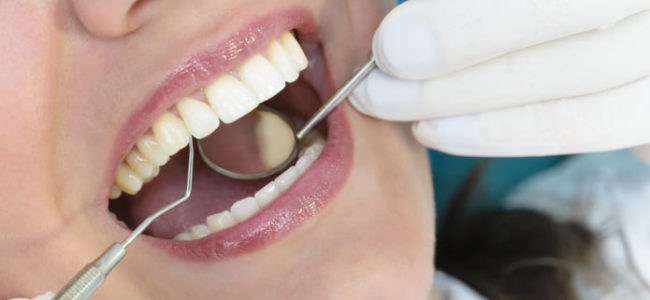 ¿Qué es el curetaje dental o raspado radicular?
