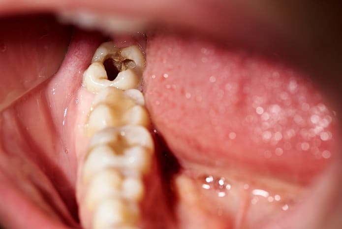 El método de biopelícula se puede utilizar para probar de forma económica nuevos tratamientos para la caries dental.