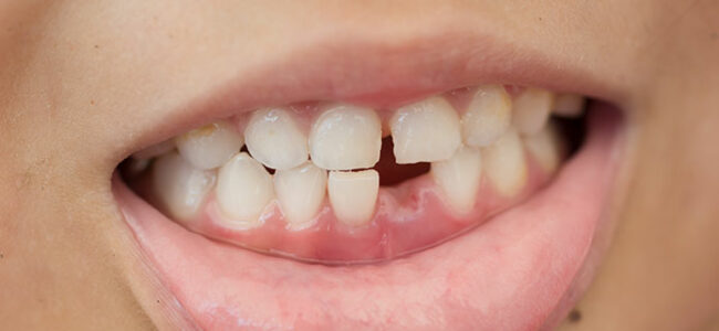 El 25% de los adolescentes experimenta traumatismos dentales