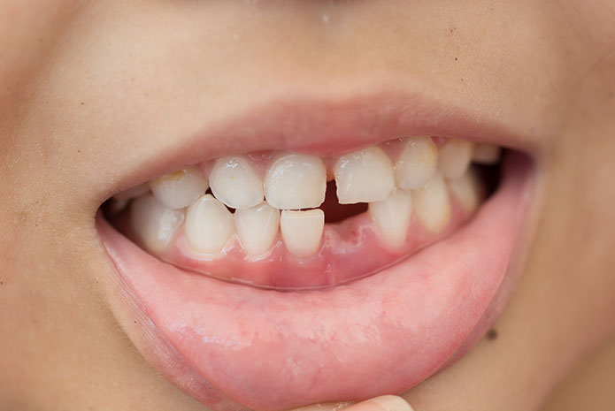 El 25% de los adolescentes experimenta traumatismos dentales
