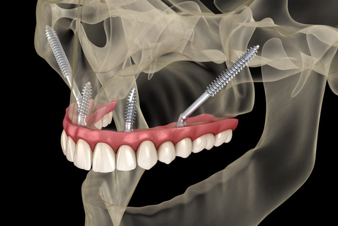 «Estos implantes se colocan en dos huesos que no se reabsorben nunca, el cigomático y el pterigoideo, por lo que pueden ser utilizados incluso en las atrofias más severas del hueso maxilar»