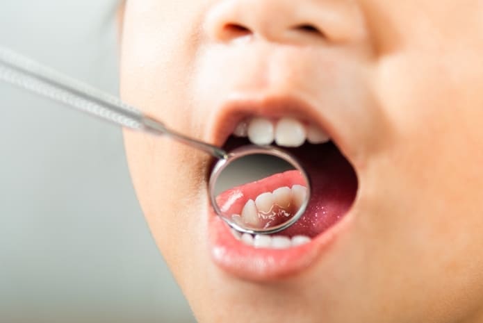 «Algunas alteraciones estructurales de los tejidos dentarios, como defectos de esmalte o morfología predispuesta, pueden generar CTI»