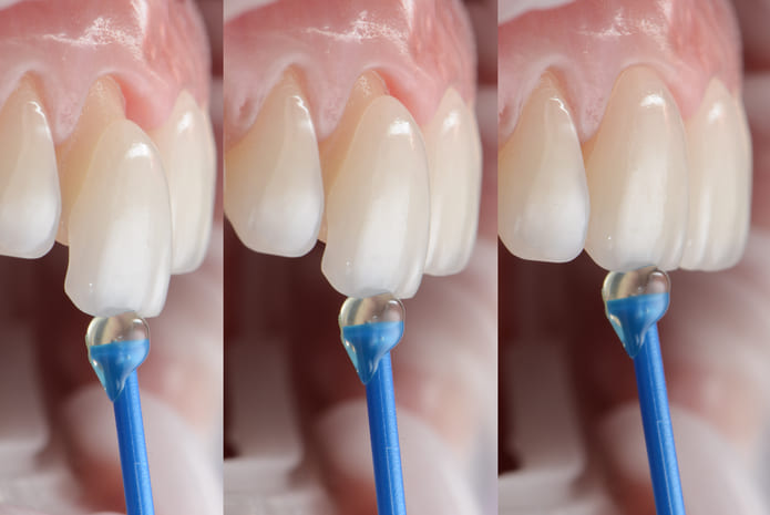 Qué ventajas tienen las carillas dentales?