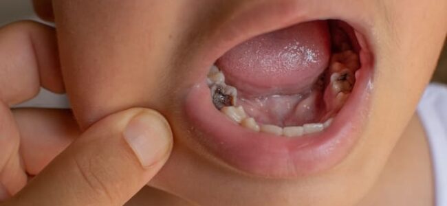 Guía de mejores prácticas clínicas para el tratamiento de lesiones cariosas profundas en dientes primarios