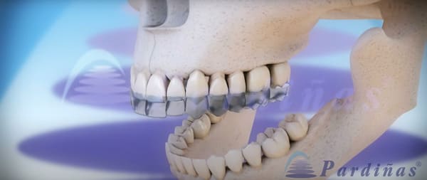 Imagen 3D en la que se puede ver la férula de descarga justo antes de encajarla en los dientes superiores. 